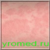  Симптомы  дерматита фото  